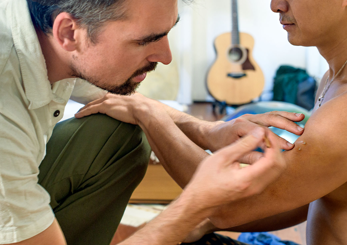 Kambô application points (gates) on the skin